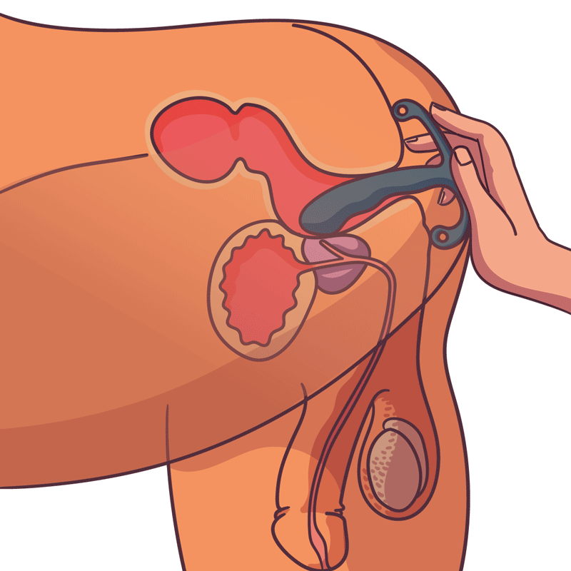 Illustratie bij informatief artikel over vergrote pros en problemen bij De Paarse Keizerin met medisch advies
